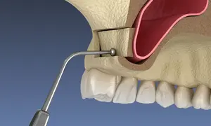 LATERAL WINDOW SINUS 1