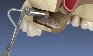 LATERAL WINDOW SINUS 2