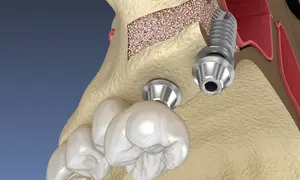 LATERAL WINDOW SINUS 3