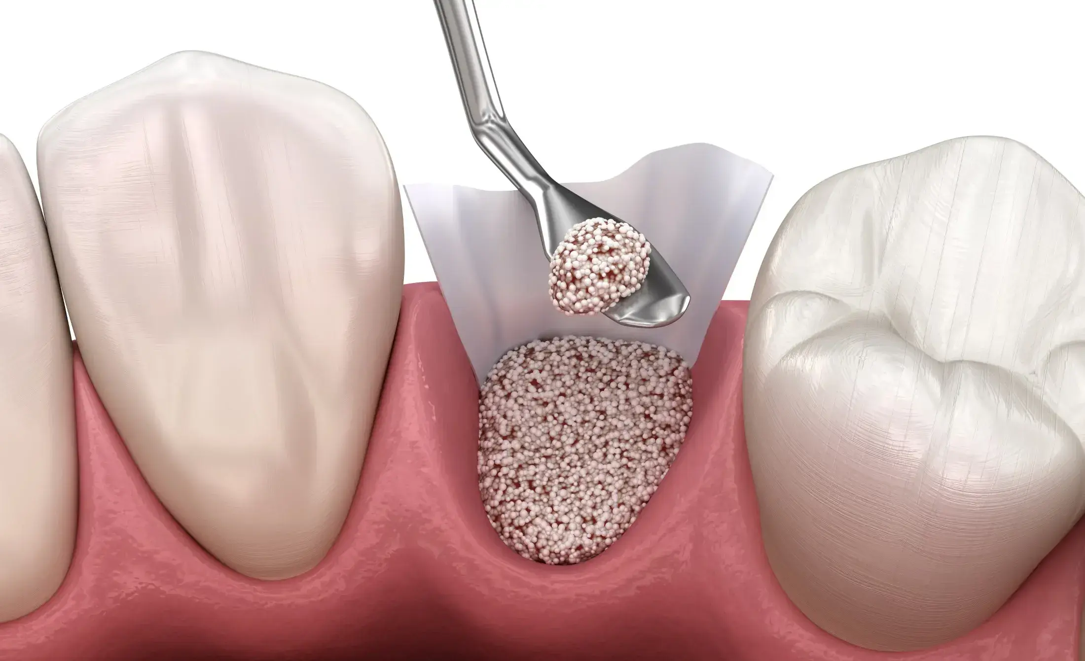 BONE GRAFT c