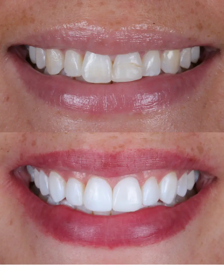 Composite bonding case 1 3