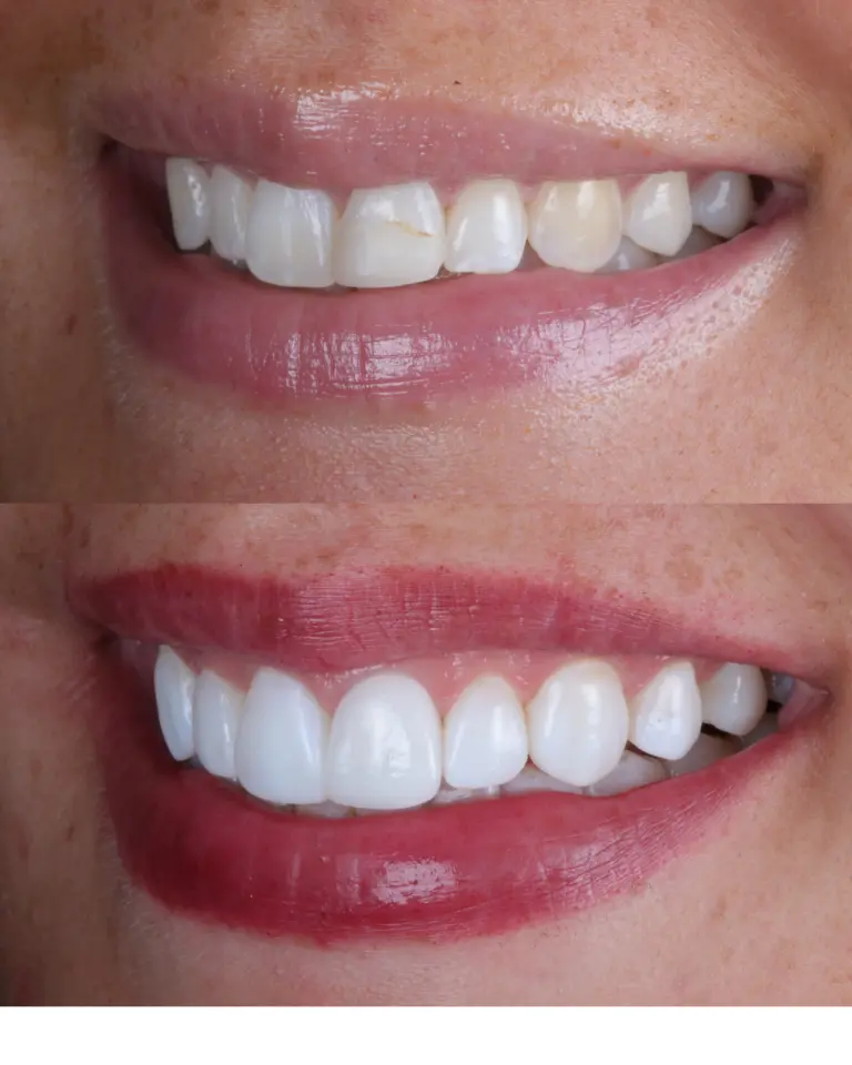 Composite bonding case 1 4