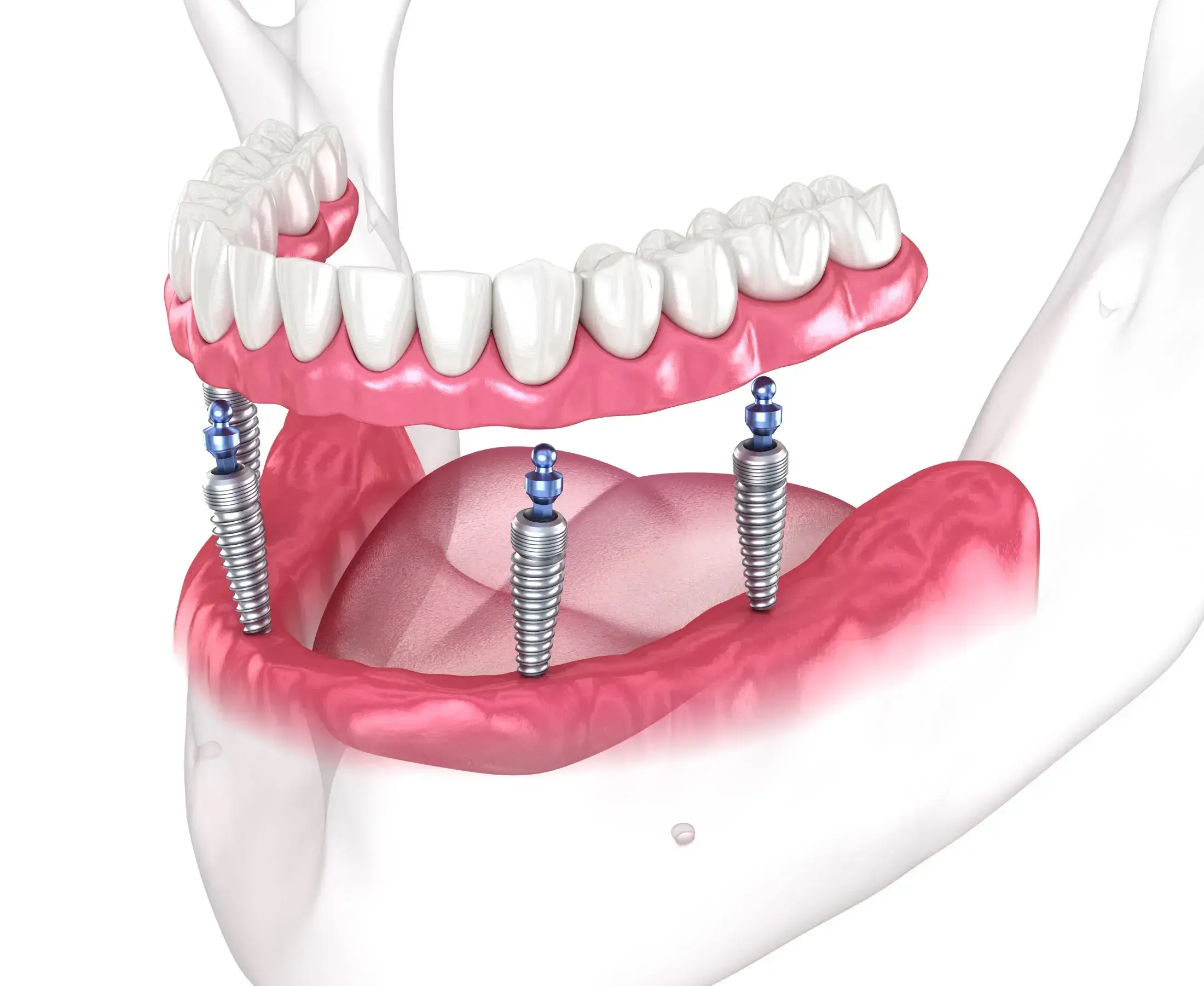 FULL ARCH IMPLANT PIC Custom