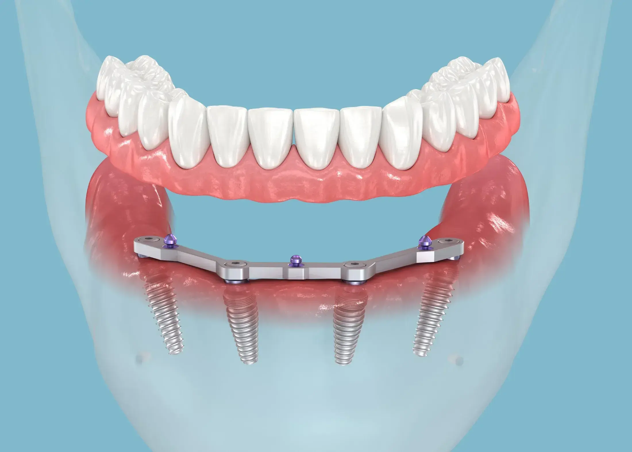 FULL ARCH IMPLANTS Custom