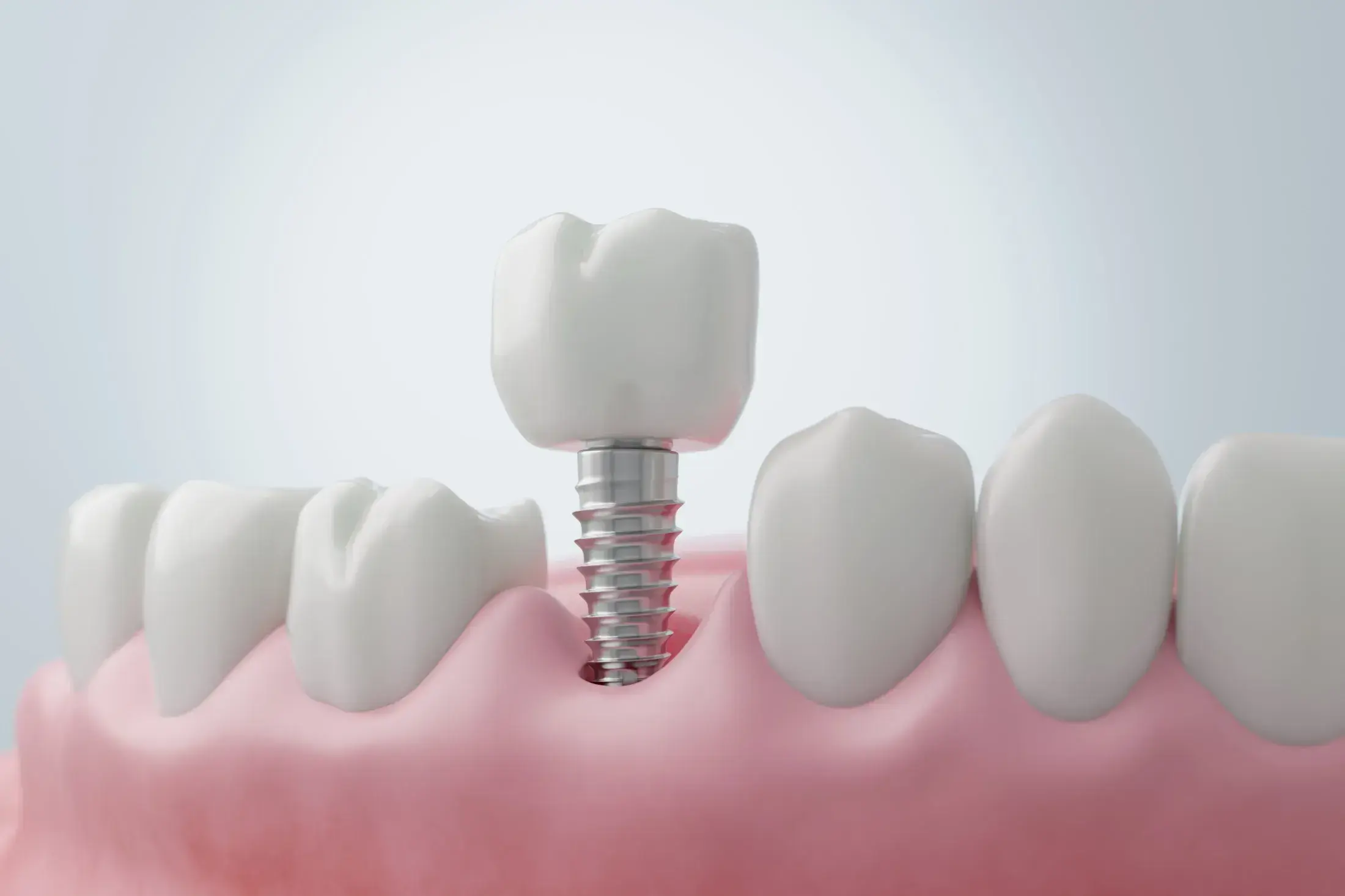 SINGLE IMPLANT Custom