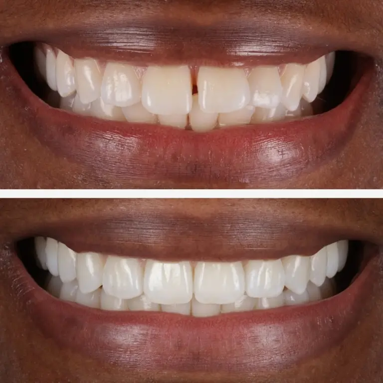 Invisalign 2