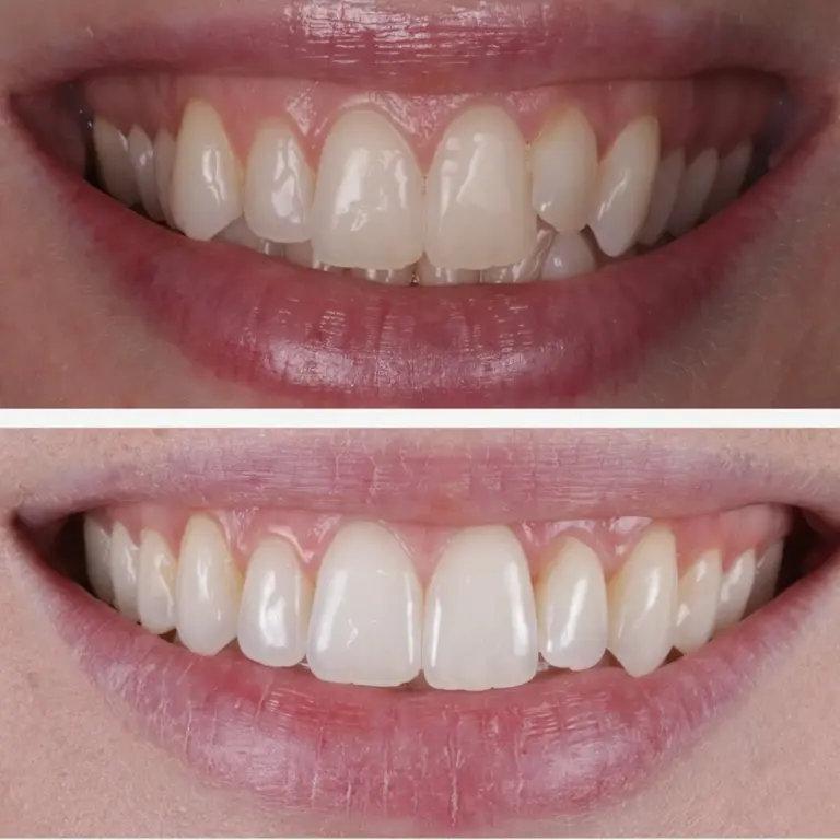 Invisalign 1