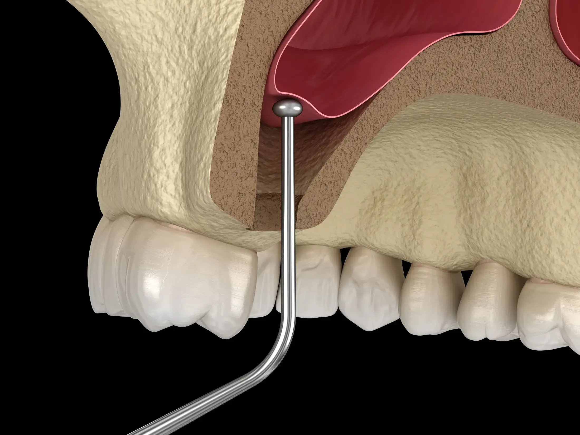 INTERNAL SINUS LIFT 1