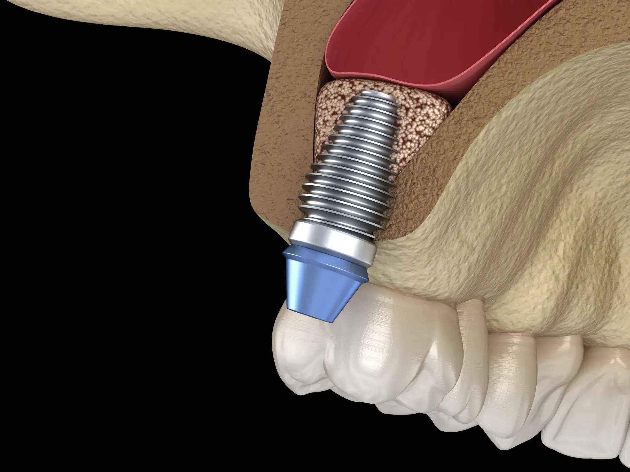 INTERNAL SINUS LIFT 3