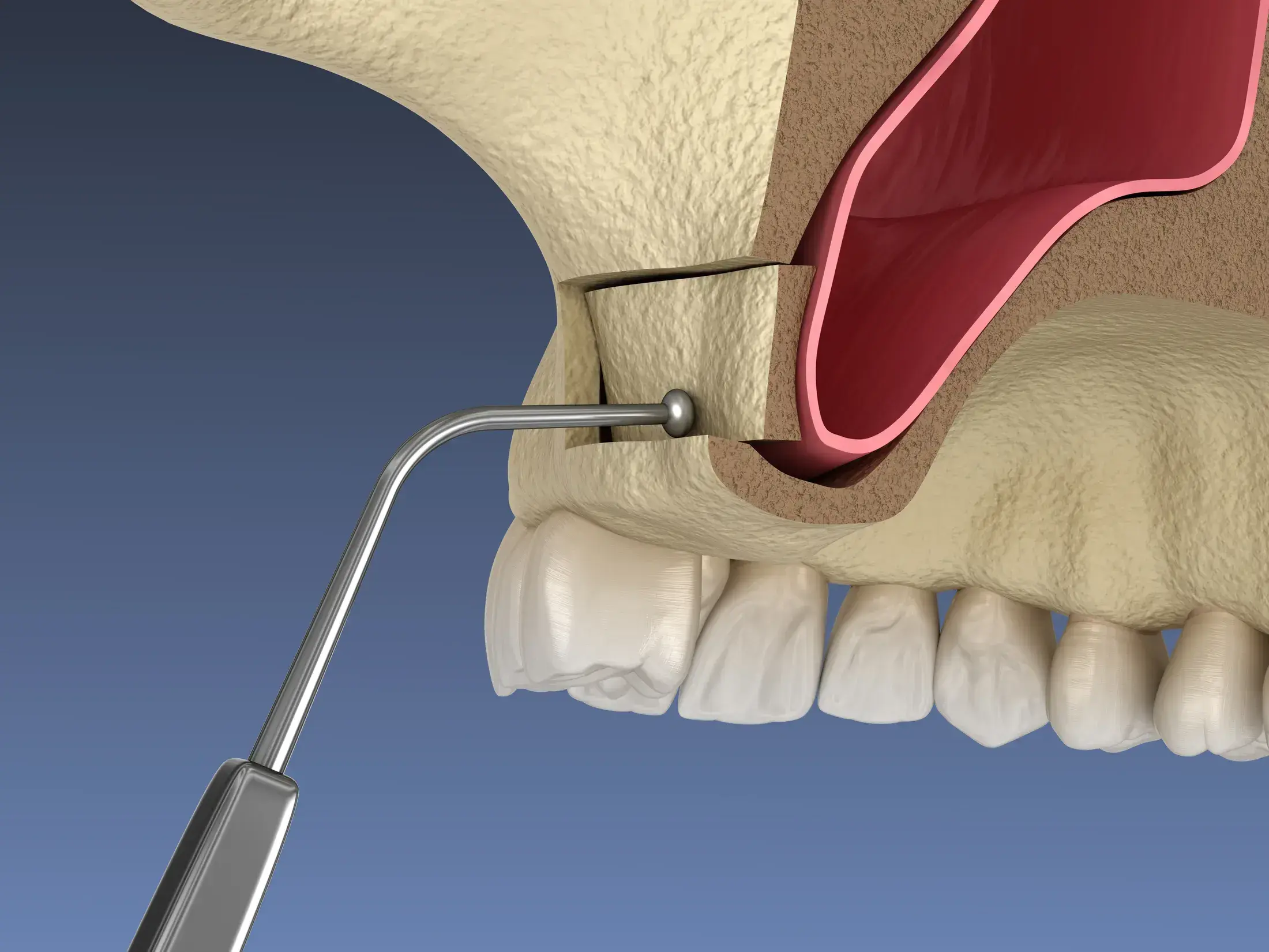 LATERAL WINDOW SINUS 1