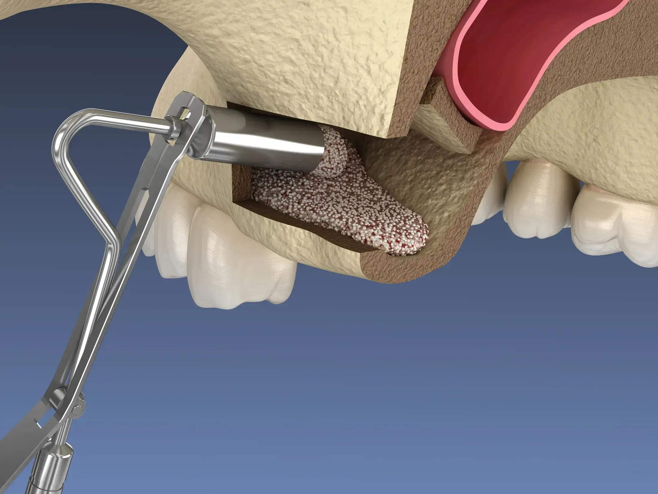 LATERAL WINDOW SINUS 2