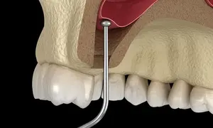 INTERNAL SINUS LIFT 1