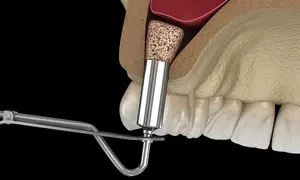 INTERNAL SINUS LIFT 2