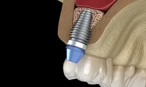 INTERNAL SINUS LIFT 3